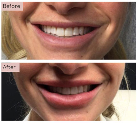lip fillers before and afters